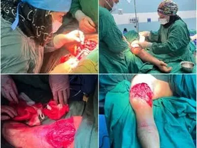 ترمیم دست قطع‌شده یک جوان طی عمل جراحی پیچیده ۶ ساعته در بیمارستان فاطمی اردبیل 