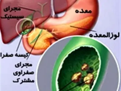 سنگ کیسه صفرا چیست و چه علائمی دارد؟