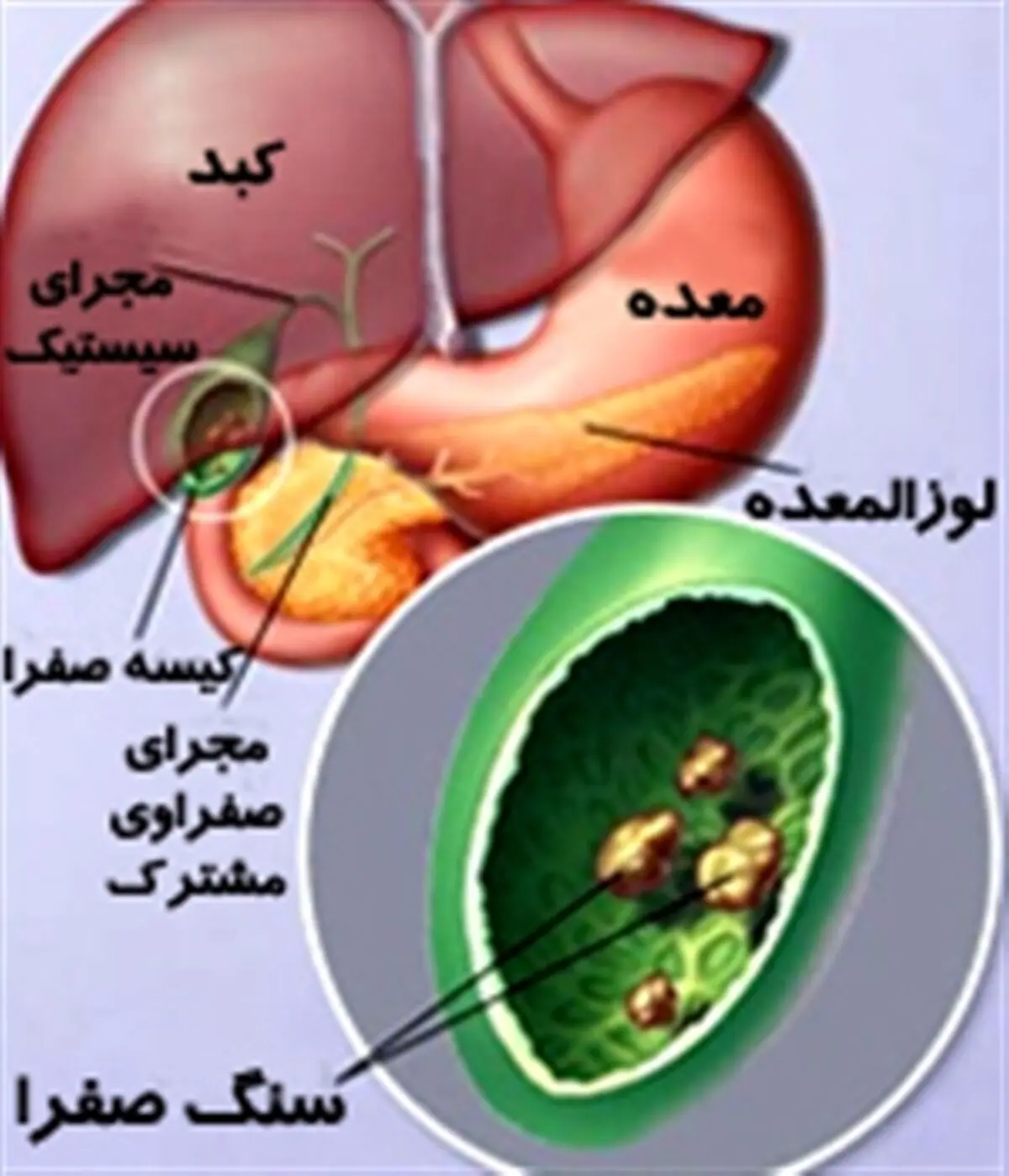 سنگ کیسه صفرا چیست و چه علائمی دارد؟