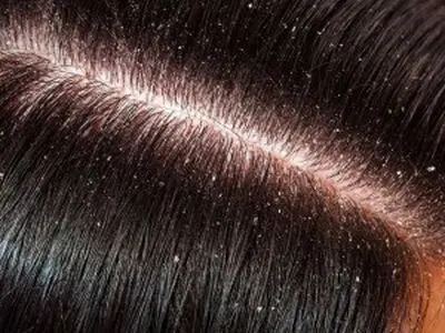 عوامل مؤثر در افزایش و بدتر شدن وضعیت شوره سر