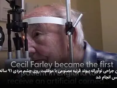 اولین نمونه موفق پیوند قرنیه مصنوعی در جهان