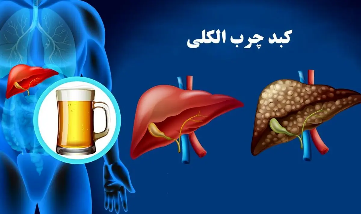 الکل دوز امن ندارد؛ آسیب‌های کبدی ممکن است تا مراحل پیشرفته خاموش بمانند