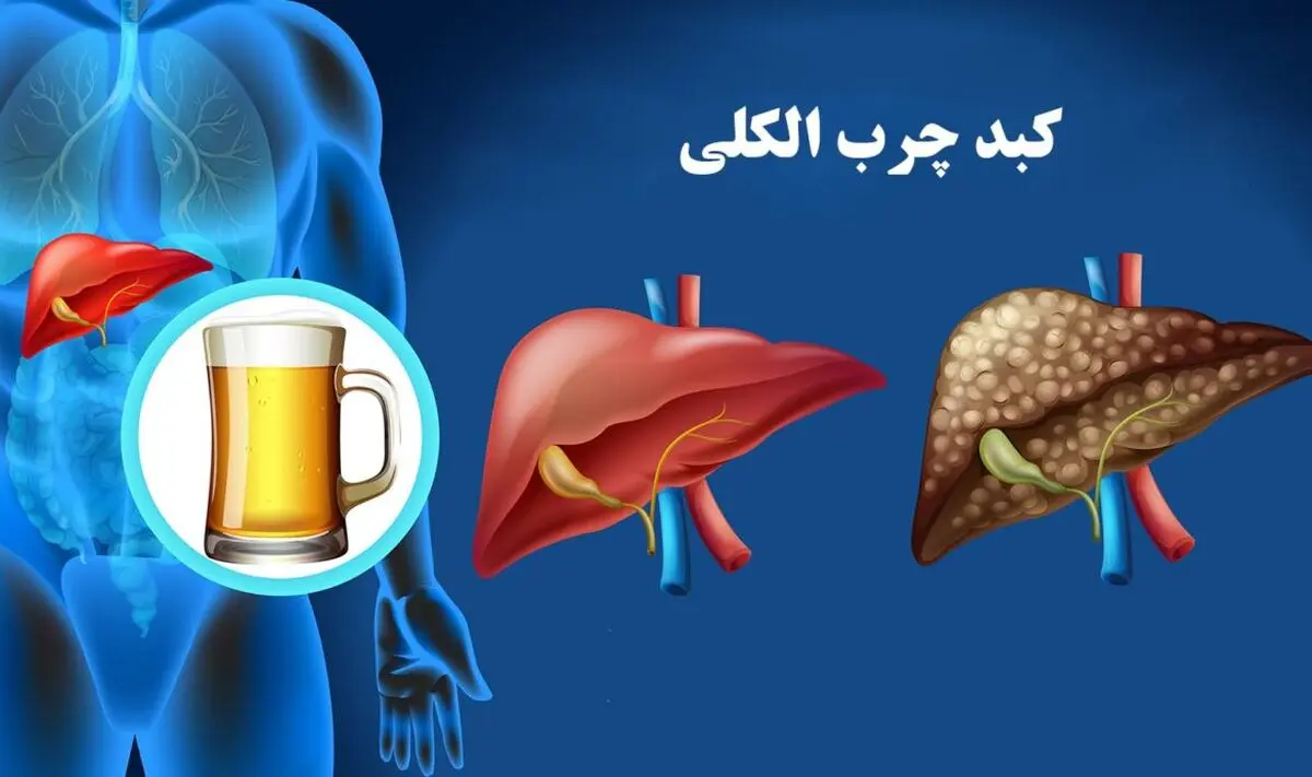 الکل دوز امن ندارد؛ آسیب‌های کبدی ممکن است تا مراحل پیشرفته خاموش بمانند