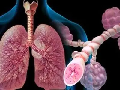 توصیه حیاتی به مبتلایان آسم؛ شهریور این واکسن را تزریق کنید