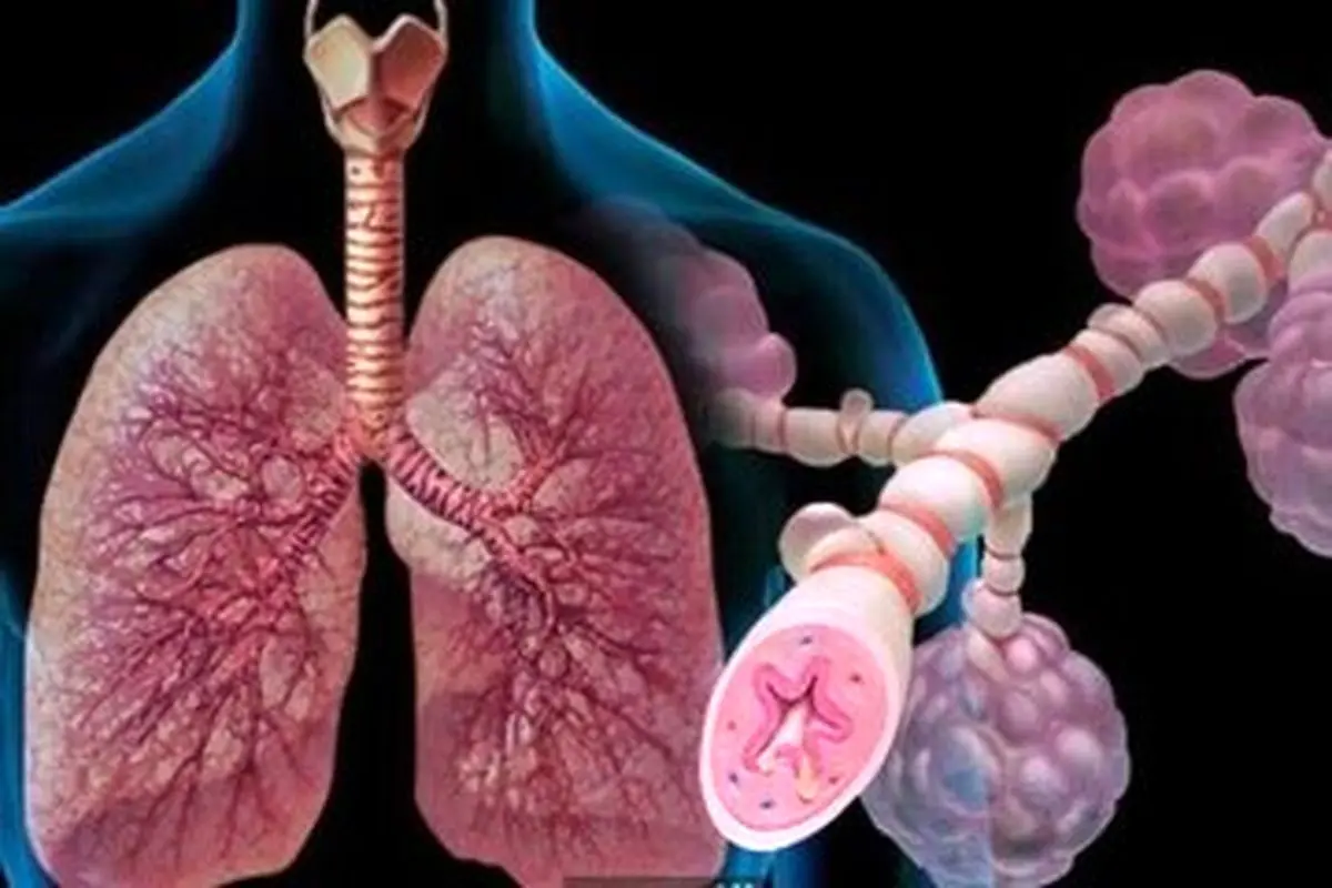 توصیه حیاتی به مبتلایان آسم؛ شهریور این واکسن را تزریق کنید