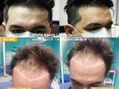 کاشت مو به روش SUT در کلینیک مدرن خانه سفید