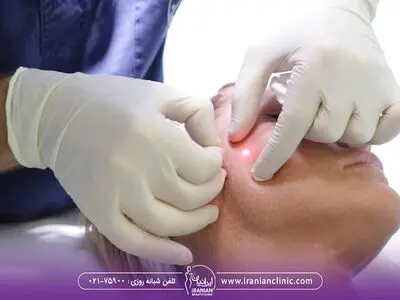 معرفی بهترین مراکز لیزر اندولیفت در تهران​
