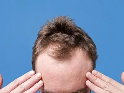 کدام ریزش مو در مردان شایع‌تر است؟