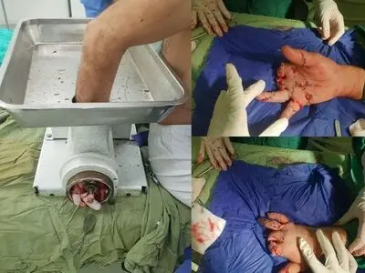 پیوند موفقیت‌آمیز انگشتان قطع‌ شده یک کارگر 