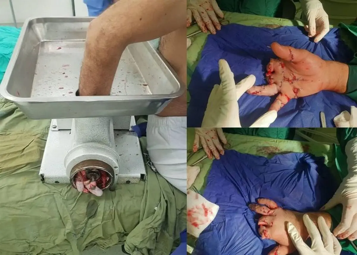 پیوند موفقیت‌آمیز انگشتان قطع‌ شده یک کارگر 