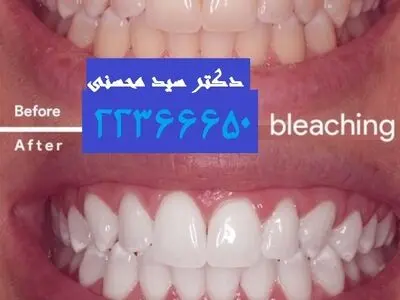 معرفی بهترین مرکز برای ونیر کامپوزیت در تهران