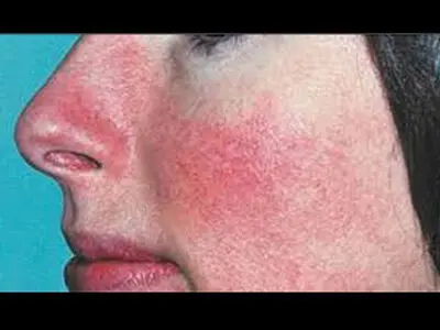 راههای کنترل اگزمای پوستی کدامند