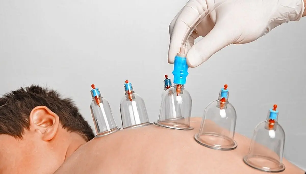 دانستنی‌هایی درباره حجامت 