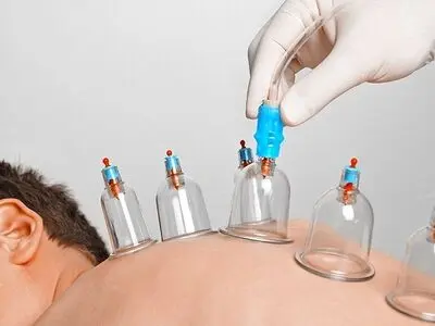 دانستنی‌هایی درباره حجامت 