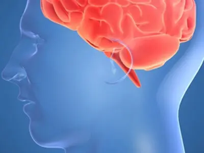 سکته مغزی ۱۴۰ هزار ایرانی در سال