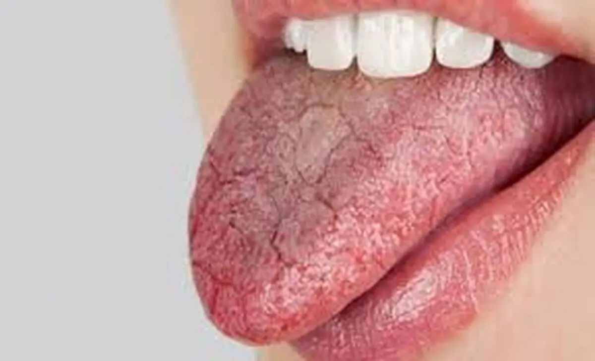 راهکارهای علمی برای تسکین خشکی دهان + اینفوگرافی