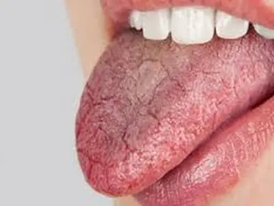 راهکارهای علمی برای تسکین خشکی دهان + اینفوگرافی