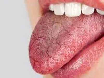 راهکارهای علمی برای تسکین خشکی دهان + اینفوگرافی