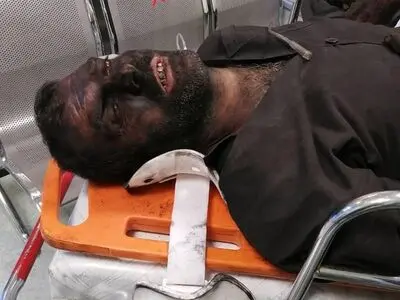 تنها بازمانده حادثه معدن زغال‌سنگ هجدک همچنان بستری است 