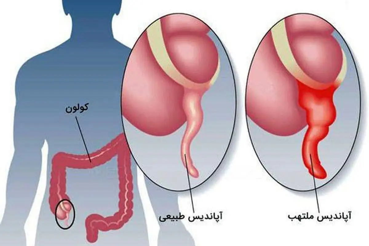 آپاندیس چیست و درمان آپاندیسیت چگونه است؟