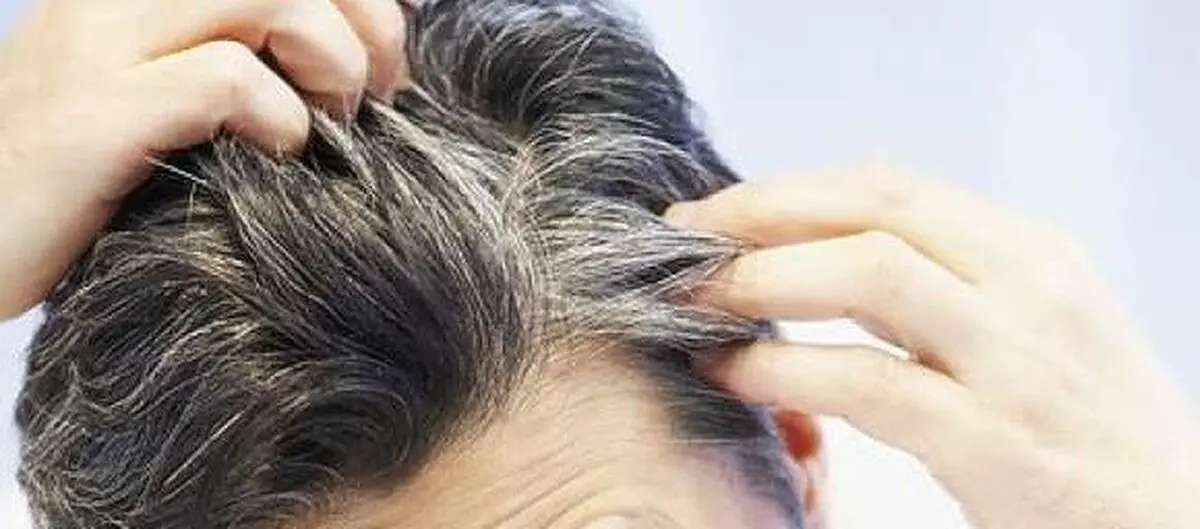 رفع سفیدی مو با این معجون