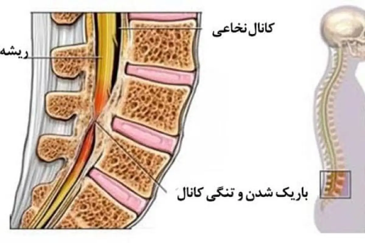 بهترین جراح تنگی کانال نخاع و ستون فقرات