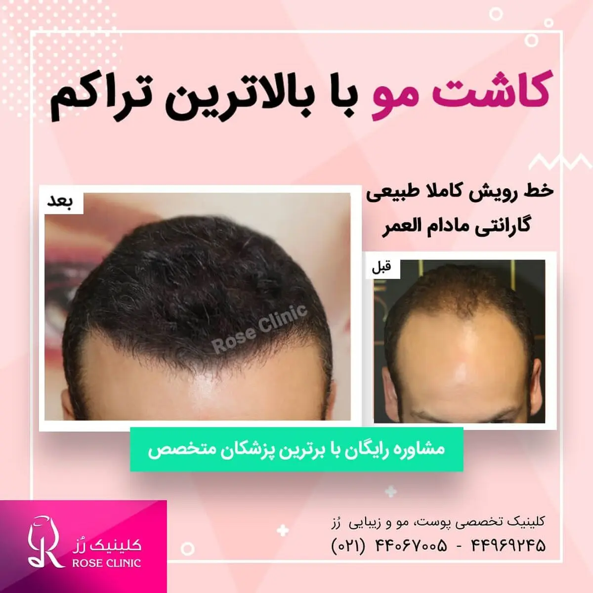 بهترین روش کاشت مو در ایران 
