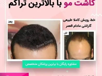 بهترین روش کاشت مو در ایران 