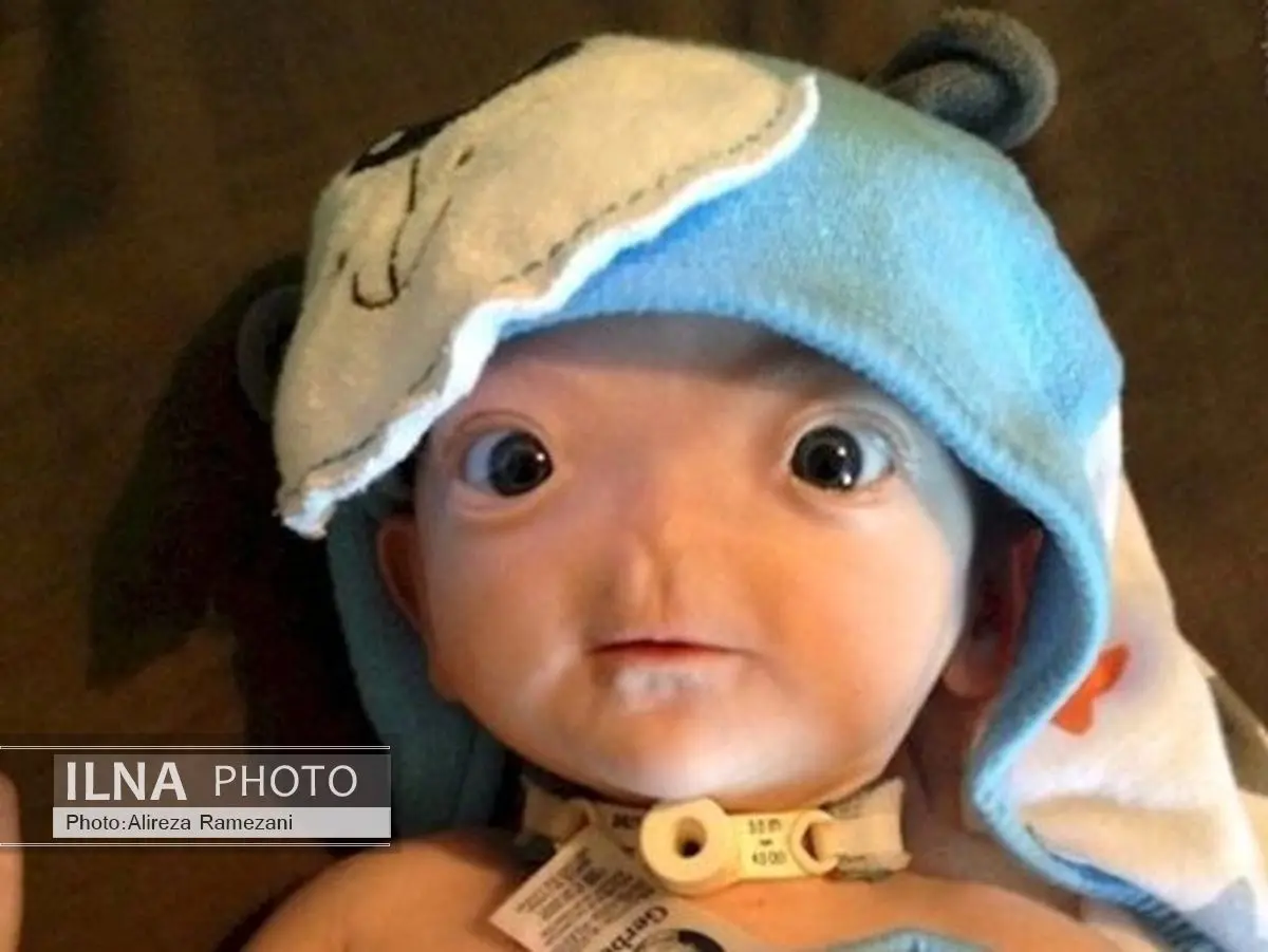 دختری که بینی ندارد + تصاویر 