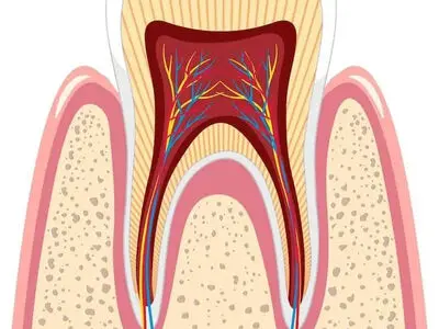 دلیل عفونت ریشه دندان چیست؟