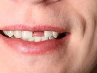مشکلات جای خالی دندان و فاصله ایجاد شده بین دندان ها
