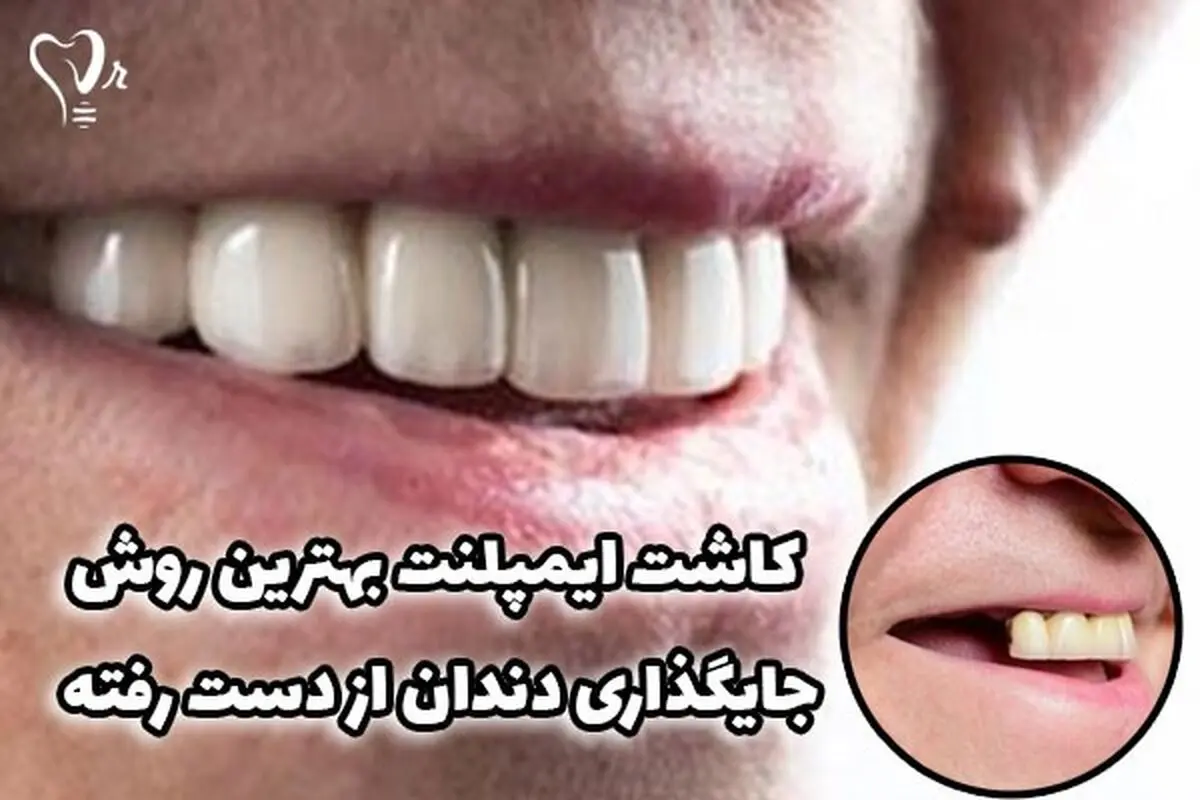 مراحل و هزینه کاشت ایمپلنت فوری تنها در یک روز