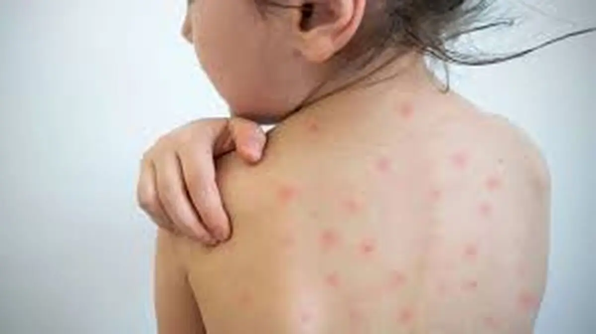 هشدار علوم پزشکی همدان به واکسیناسیون کودکان علیه سرخک