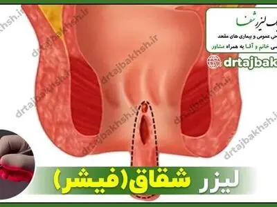 شقاق یا فیشر چیست؟