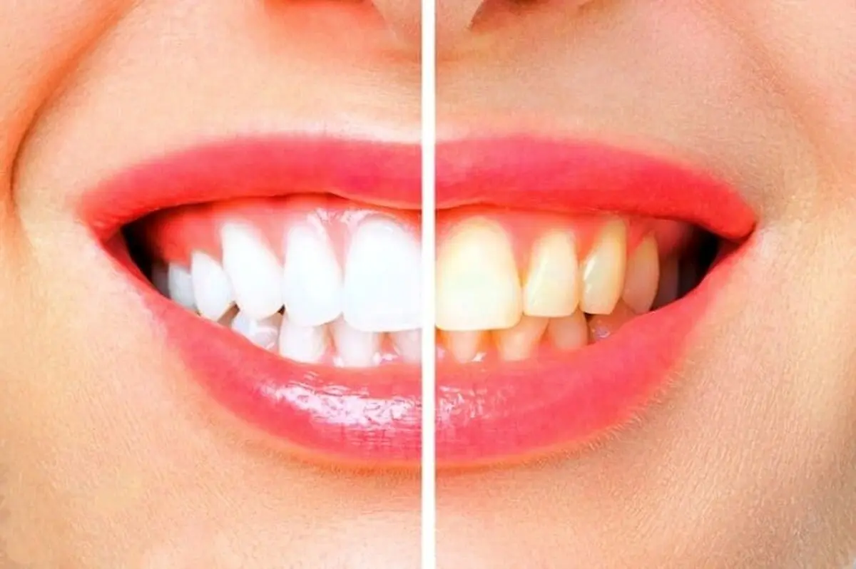 چگونه جرم و پلاک های دندان را در 5 دقیقه رفع کنیم؟