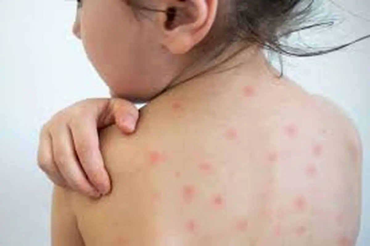 هیچ مورد مثبت سرخک در آذربایجان شرقی وجود ندارد