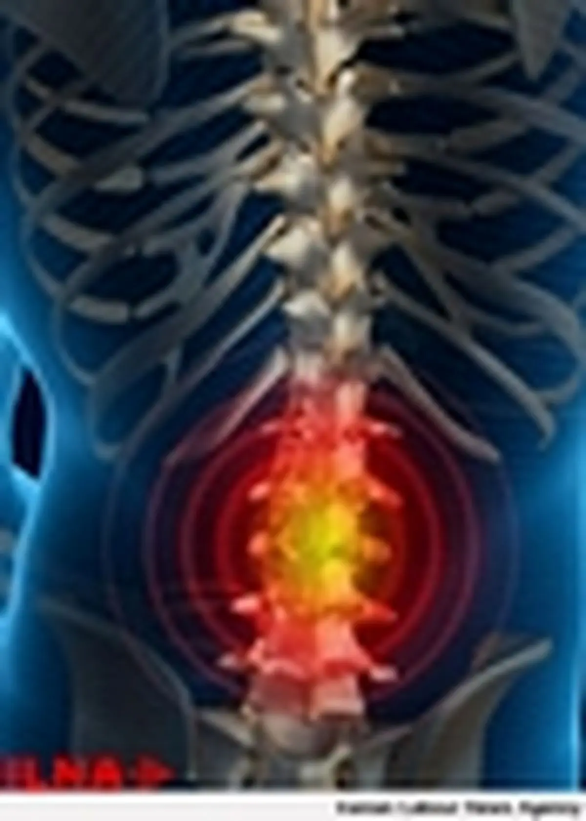 کمر درد سومین علت شایع جراحی در دنیاست