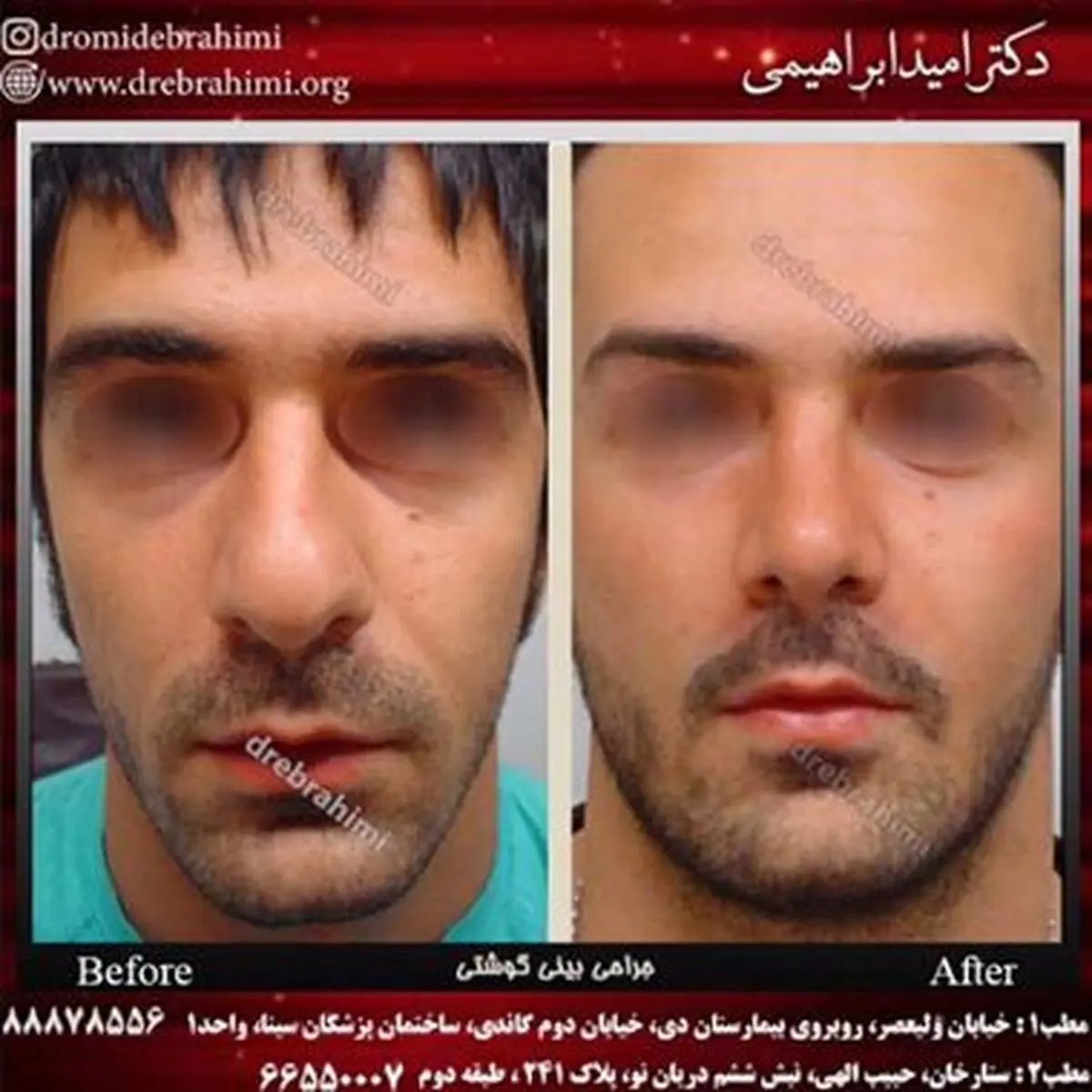 جراحی بینی طبیعی