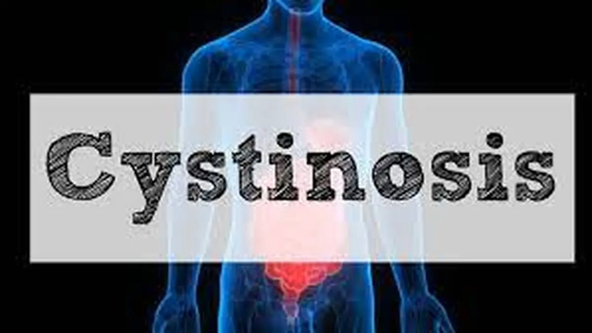 «سیستونوزیس» بیماری ناشناخته برای پزشکان و جامعه/ پسرم روزی ۸۰ عدد قرص می‌خورد