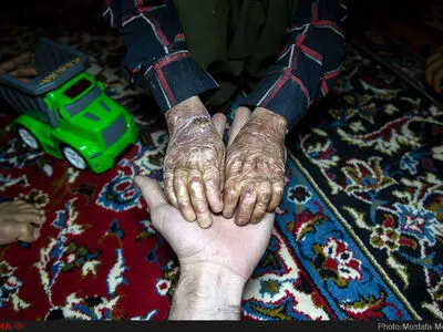 رنج کودکان پروانه ای جنوب کرمان در سایه بی توجهی مسئولین بهداشتی کشور