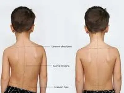 حرکات اصلاحی برای افتادگی شانه+ فیلم