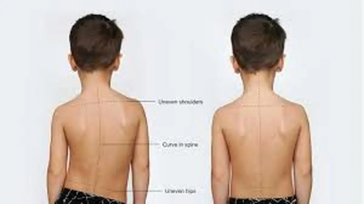 حرکات اصلاحی برای افتادگی شانه+ فیلم