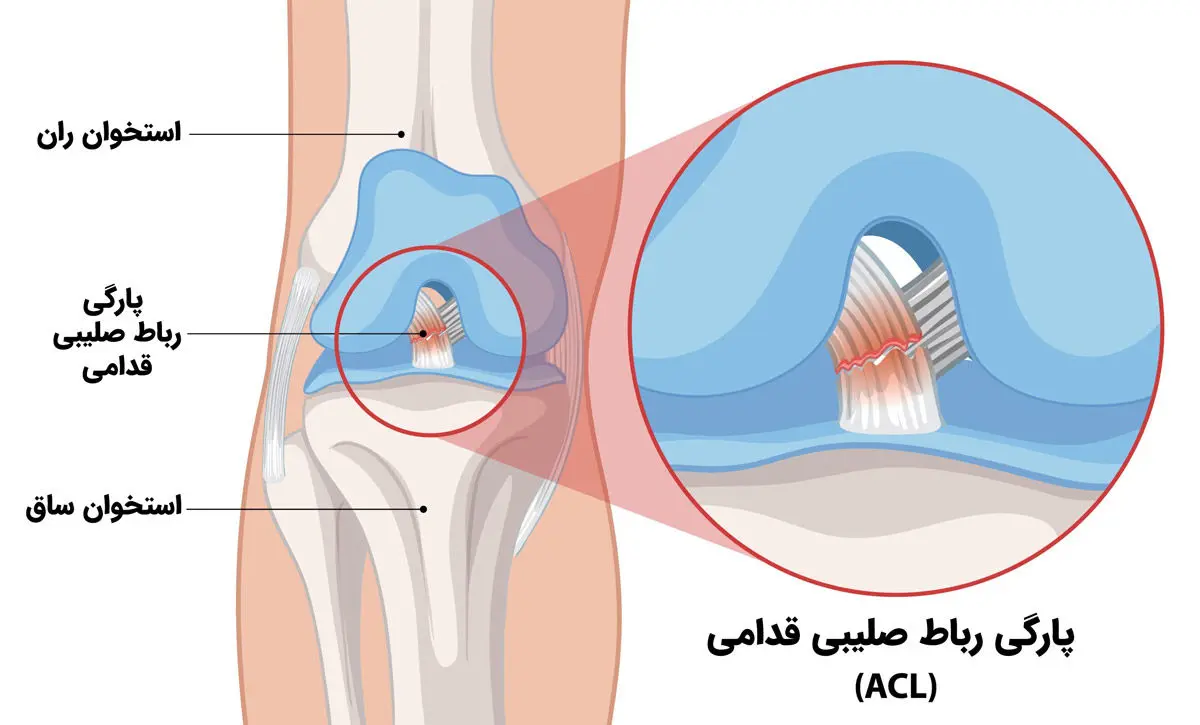 جراحی رباط صلیبی با پرده جفت جنین؛ روشی نوین در درمان پارگی رباط