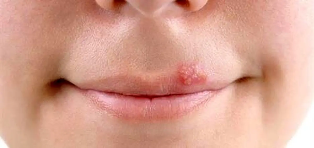 آیا راهی برای جلوگیری از عود تبخال وجود دارد؟