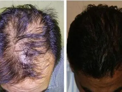پلمب کلینیک درمانی کاشت مو غیرمجاز در کاشان