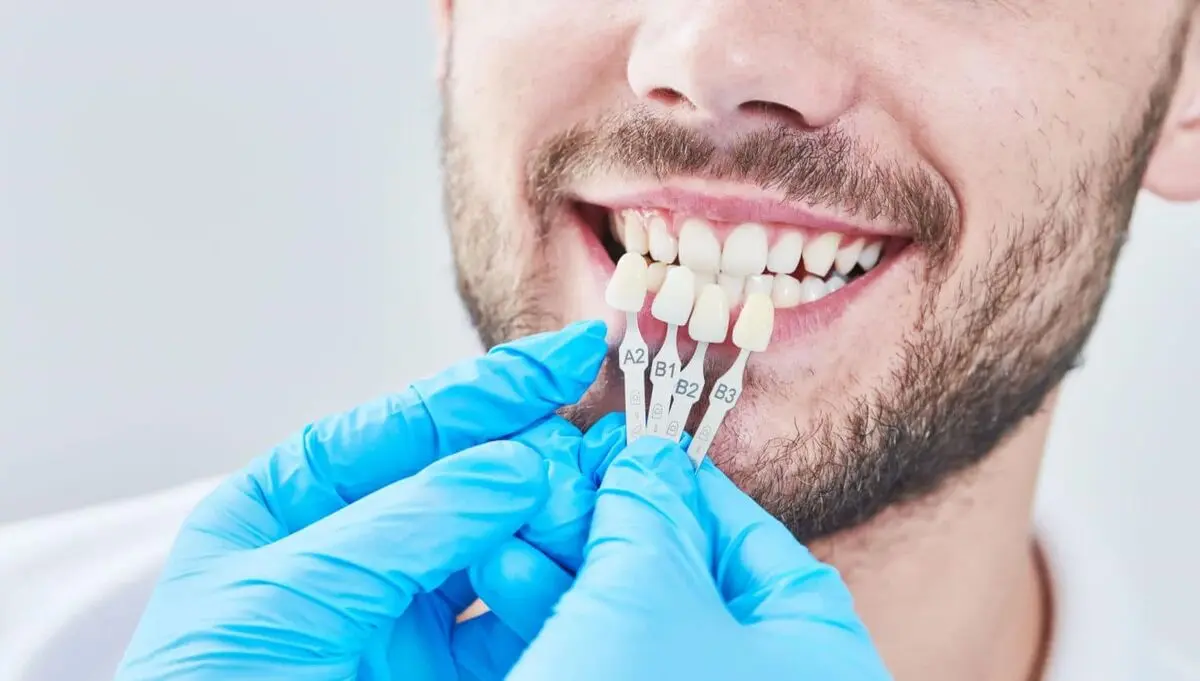تفاوت لمینت و کامپوزیت دندان چیست؟
