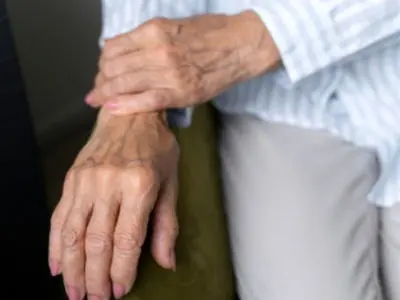 درمان بیرون زدگی رگ دست با روش‌های سنتی