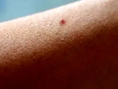 روش از بین بردن موهای زیرپوستی بعد از لیزر
