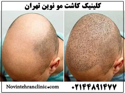 کدام کلینیک را برای کاشت مو انتخاب کنیم