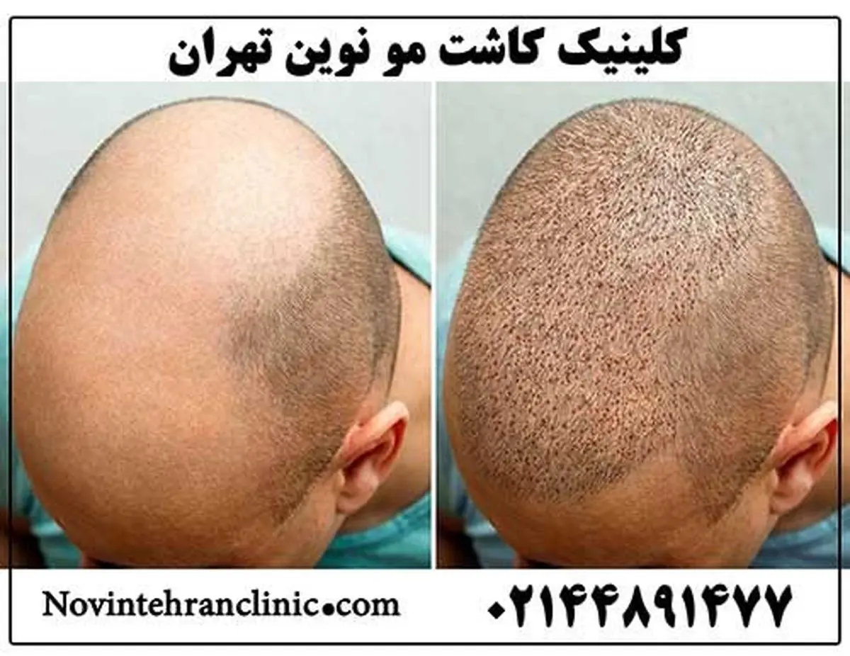 کدام کلینیک را برای کاشت مو انتخاب کنیم